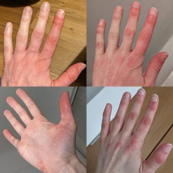 Erythromelalgia on hands