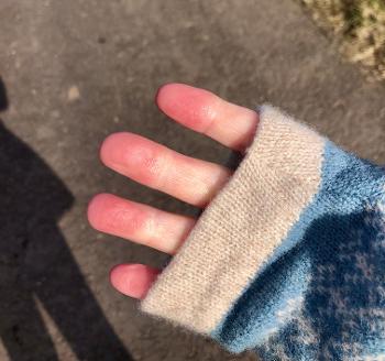 Raynaud’s and neuropathy when red - called Erythromelalgia(spelt?) I think