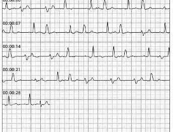 ECG showing ectopic beats with LBBB