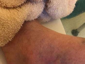 Bruise left ankle
