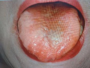 Typical B12 deficiency tongue photo