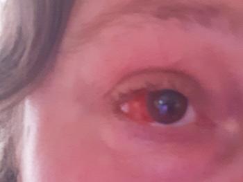 Scleritis in right eye 
