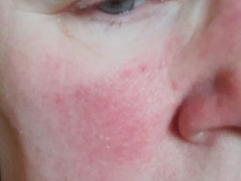 Close up of cheek to show rash