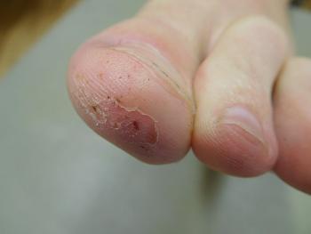 Ibrutinib can cause dermatitis, nail spitting and petechiae