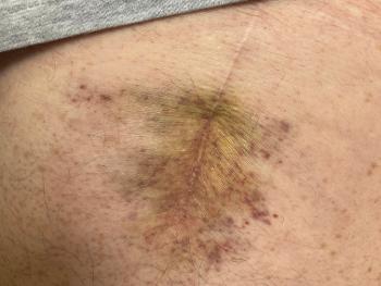 Bruise on hip bursitis after total hip replacement 