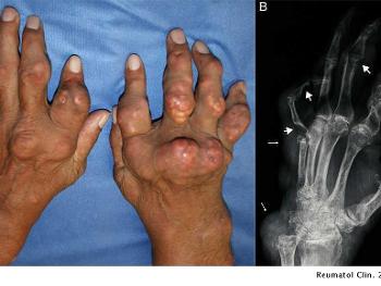 Tophus gout in the hands and joint erosions.