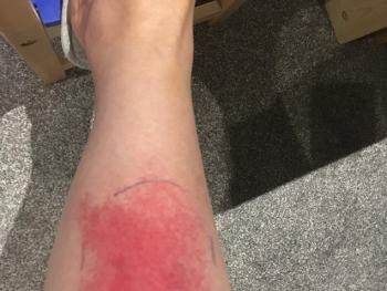 Inflamed insect bite on leg.