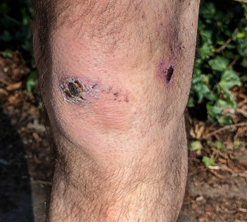 A knee, with scabs.
