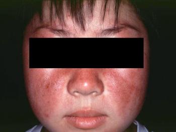 SLE Malar Rash