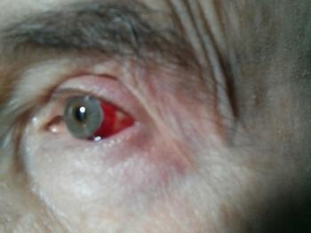 eye showing prednisone encouraged bleed