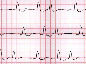 ECG trace showing PAC couplets.