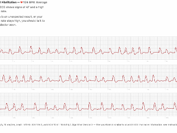 Apple Watch ECG fast AF