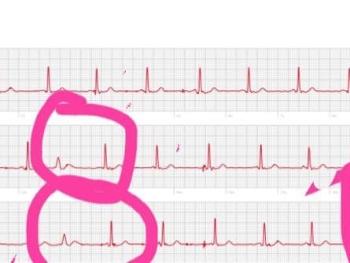 Ecg with pink circles to indicate areas 