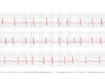 Atrial Flutter with variable block