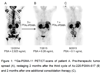 Image showing possible results of Ac225 therapy