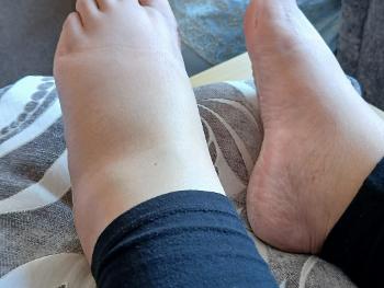 Picture of swelling on leg as example