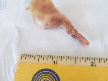 this is osteonecrosis! pictured is dead jaw bone that came from my jawbone.