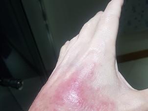 Eczema flare after treatment stopped. CRP and ESR remained normal.