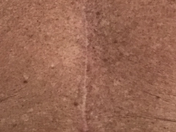 Chest scar