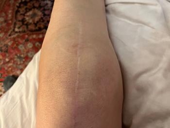 Picture of knee showing faded scar