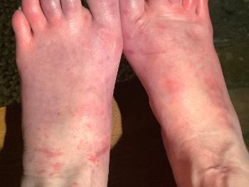 My Oedema was 6/10 in this recent pic, but during it fluctuates to 9/10 daily