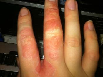 Worst my hands got and I was signed off for 2 weeks skin was peeling off and infected