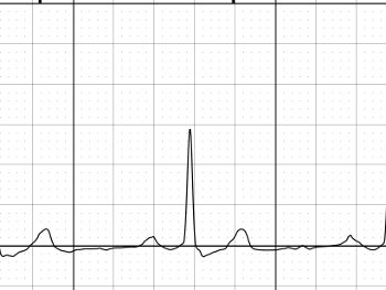 Kardia trace showing NSR-normal sinus rhythm.