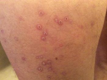 Itching and rash 