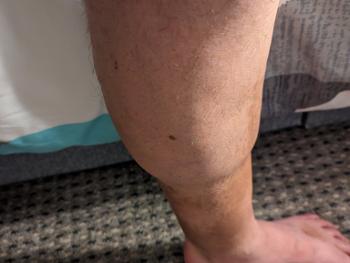 Leg swelling 