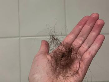 Hand held out showing hair loss