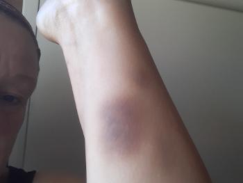 1 asprin and two ticagralor a day and this is one of my milder bruises lol