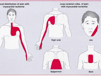 Pain I get which I attribute to angina.