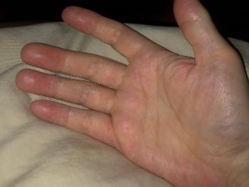 Burning red distal finger digits https://www.sruk.co.uk/scleroderma/erythomelalgia/