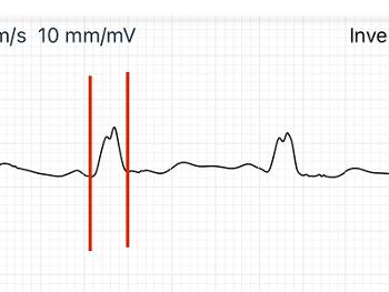 Measurement of QRS