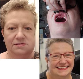 pictures of my tooth removal journey