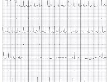 Conversion pause caught on kardia 