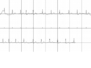 ECG showing permanent AF from Kardia ECG device