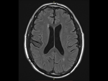 MRI of brain