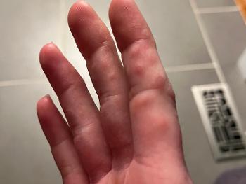 Hand with bumps along the fingers 