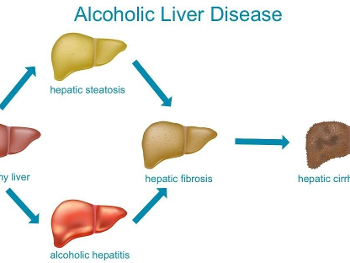 Progression of liver disease in Alcohol Related Liver issues