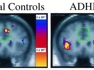 FMRI of anterior cingulate. This part of the brain controls decision making/reward/motiva