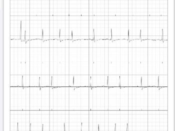 EKG Reading 