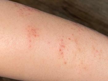 Dermatitis Herpetiformis, red rash woth spots on skin