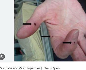 Vasculitis spots on fingers.
