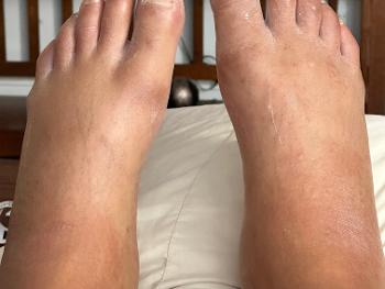 Inflammation and edema 