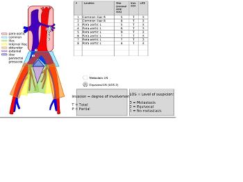 para-aortic metastases