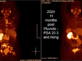 comparison of two pet scans showing results before and after Pluvicto