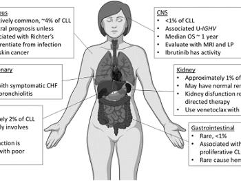 Sites of extranodal involvement in CLL.