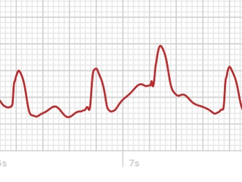 Apple Watch ECG showing AF with no P waves.