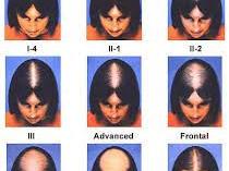 Ludwig Scale for Female hair loss
